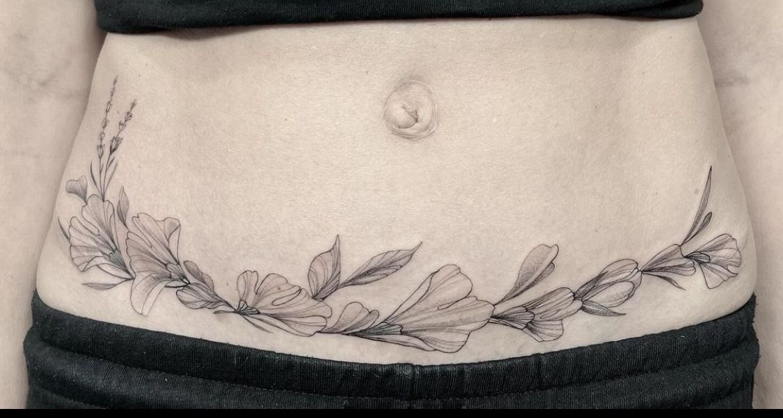 Tapado de cicatriz de abdominoplstia.